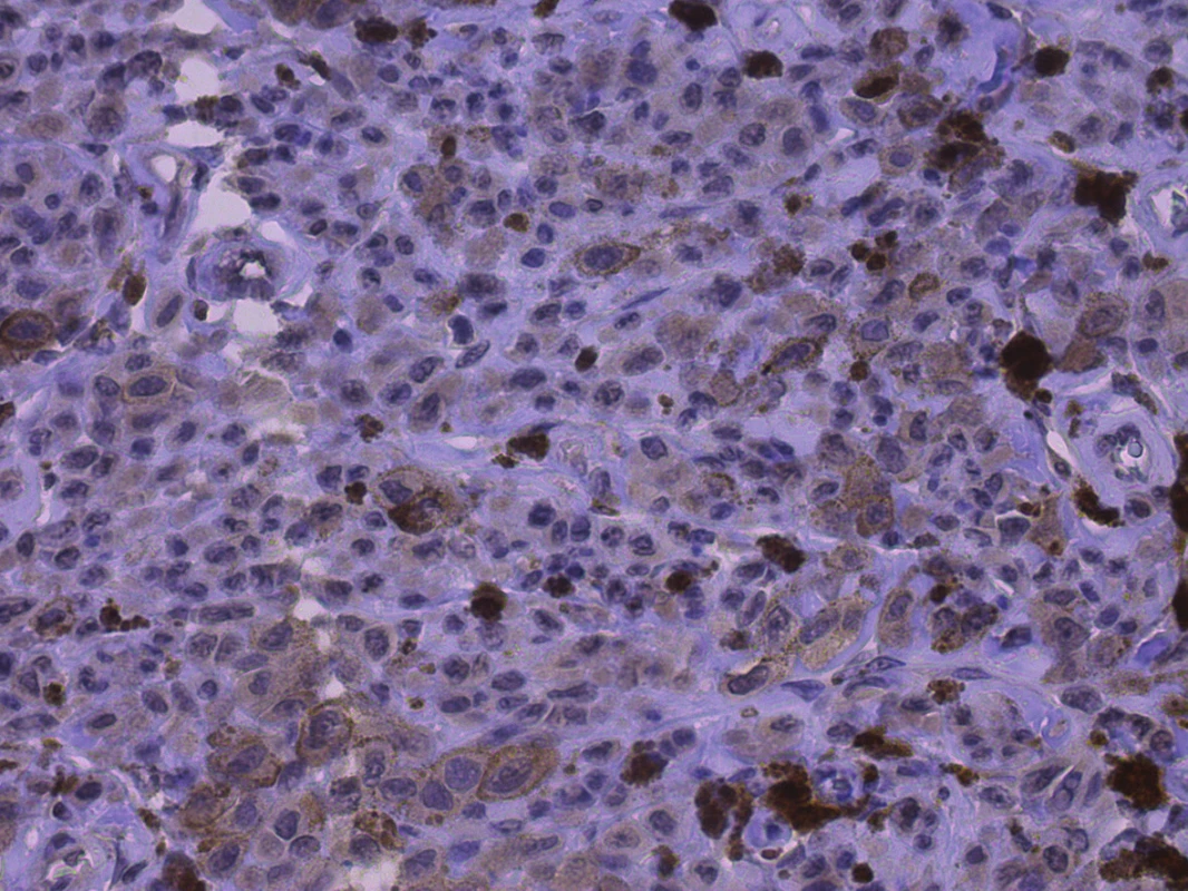 Pozitivita CD133, jemně granulární cytoplazmatická a membránová pozitivita v buňkách melanomu