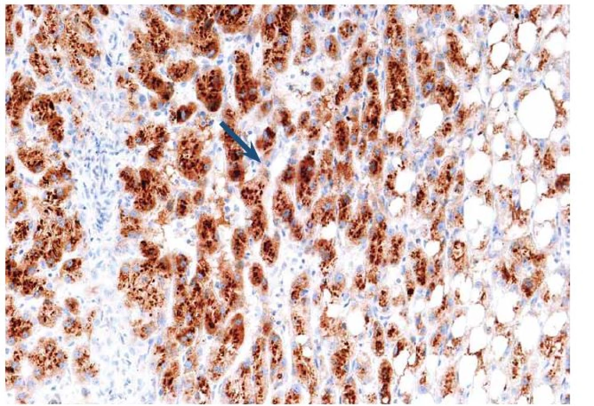 Imunohistochemický průkaz serum amyloid A (SAA) s granulární pozitivitou v hepatocytech odpovídá tzv. zánětlivému adenomu.
Fig. 9. Immunohistochemical detection of serum amyloid A (SAA) with granular positivity in hepatocytes corresponds to the inflammatory adenoma.