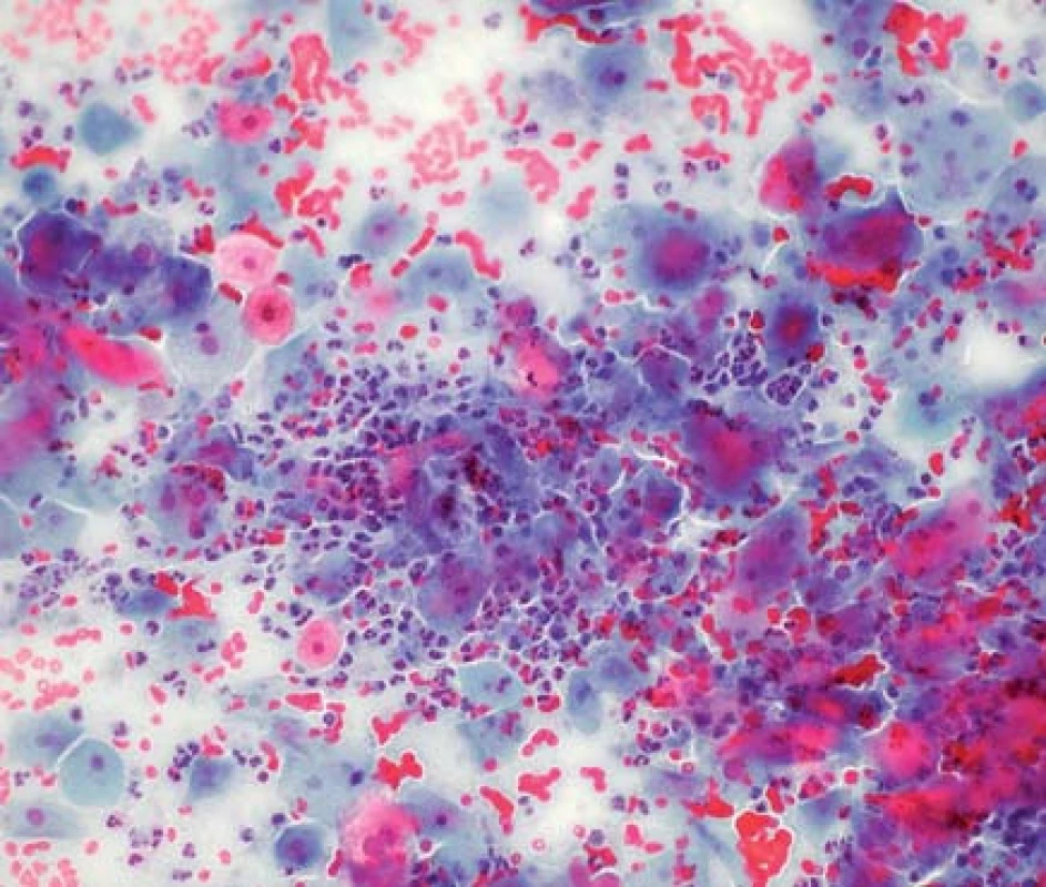 Konvenční cytologie s erytrocyty a polynukleárními leukocyty na pozadí, NILM (zvětšeno 200×)