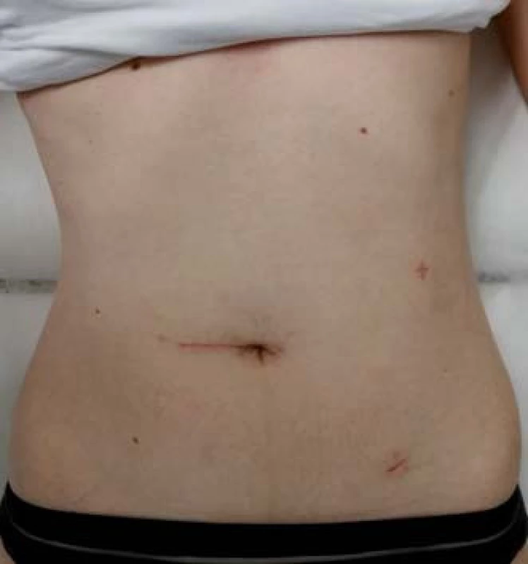 Výsledný kosmetický efekt po laparoskopicky asistované ileocekální resekci.
Fig. 1. Final cosmetic outcome after laparoscopic- assisted ileocecal resection.