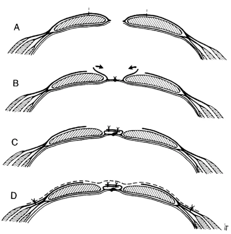 Narezanie prednej pošvy priamych brušných svalov, sutúra ich mediálnych okrajov a onlay uloženie sieťky (metóda sec. Chevrel)
Fig. 1. Incisioning of the mm. recti abdominis ventral sheath, suturing of their medial edges and on-lay application of the mesh (the Chevrel method)
