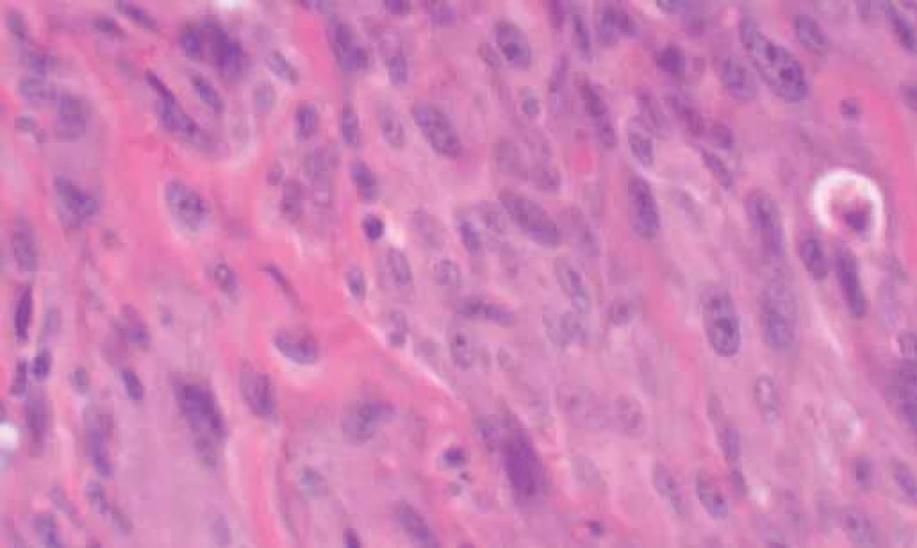 Proliferation of elongated cells with poorly defined limits, dense eosinophilic cytoplasm, vesiculous or dense nuclei, irregular nuclear membrane and small to moderate diameter variation (400×).