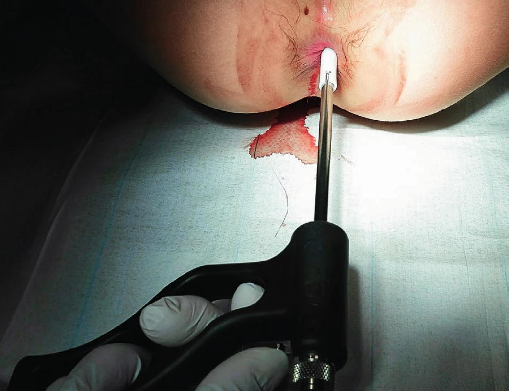 Odběr vzorků tkáně rektální sací podtlakovou sondou (zdroj: archiv autora).
Fig. 2. Tissue sampling by using suction rectal probe (author’s archive).