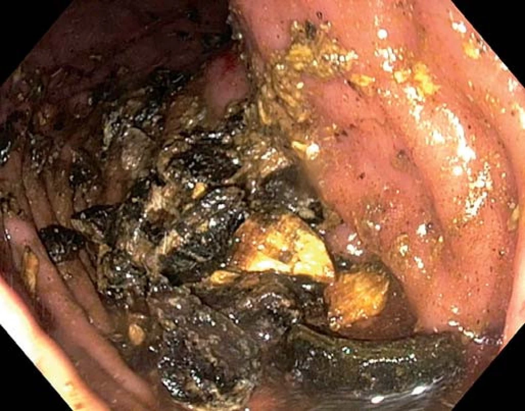 Fragmenty konkrementu.
Fig. 	3. Gallstone fragments.