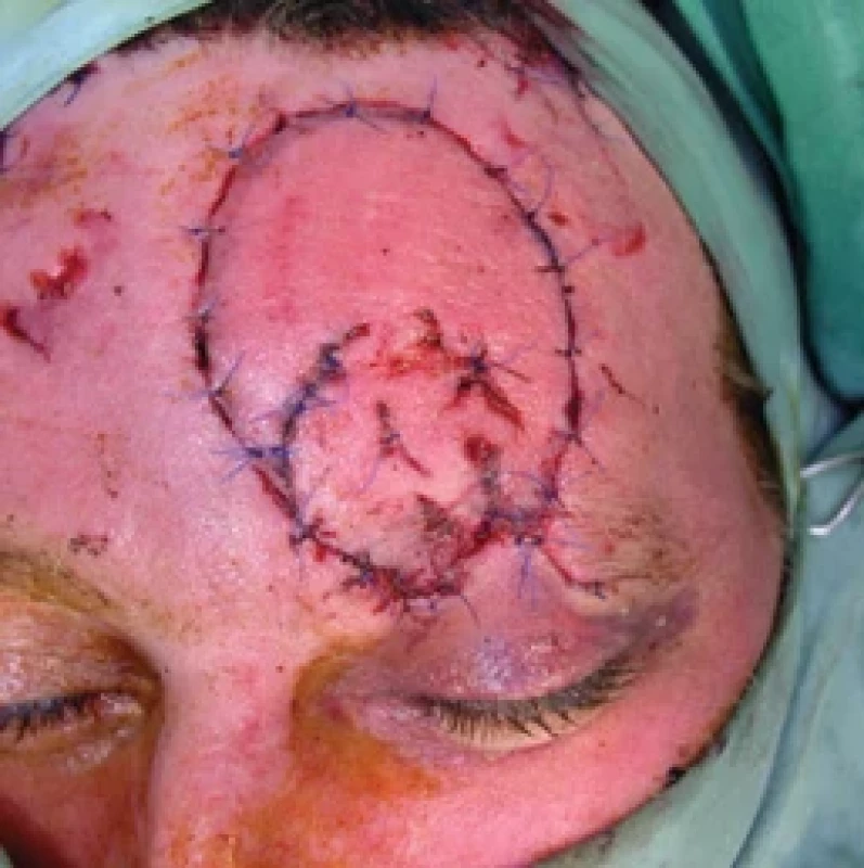 Flap reperfusion after revision surgery. Source: archive of authors.