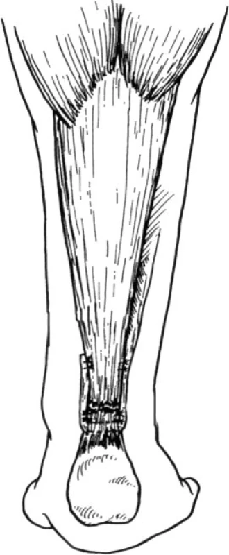 Modifikace dle
Turco a Spinella [14] (Volně podle Turco, V.J., Spinella, A.J. Achilles tendon rupture – peroneus brevis transfer. Foot and Ankle. 7, 253–259, 1987. )
