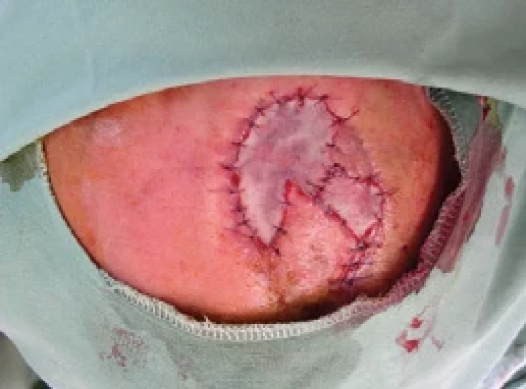 FTSG defect covering. Source: archive of authors.