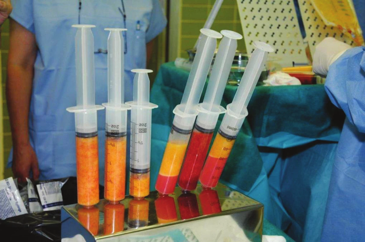 Vpravo tuk po odsátí před zpracováním, vlevo po zpracování metodou PureGraft
Fig. 1: Right: fat after liposuction before processing, Left: graft after processing using the PureGraft