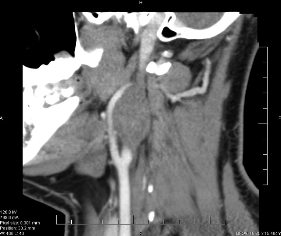 CT dokumentace rezistence v oblasti větvení ACCl. dx.
Fig. 2. CT view of the neoplasm in regional branch out of ACC l. dx.