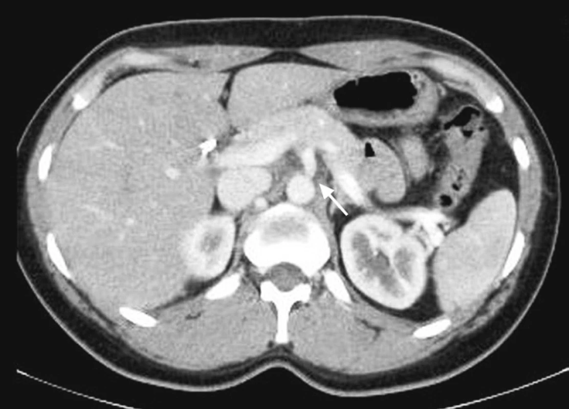 CT vyšetření s bolusem kontrastní látky intravenózně v arteriální fázi zaměřené na odstup truncus coeliacus, kde je patrná krátká stenóza
Pic. 4. CT scan with arterial phase enhancement focused at the celiac axis shows a short stenosis