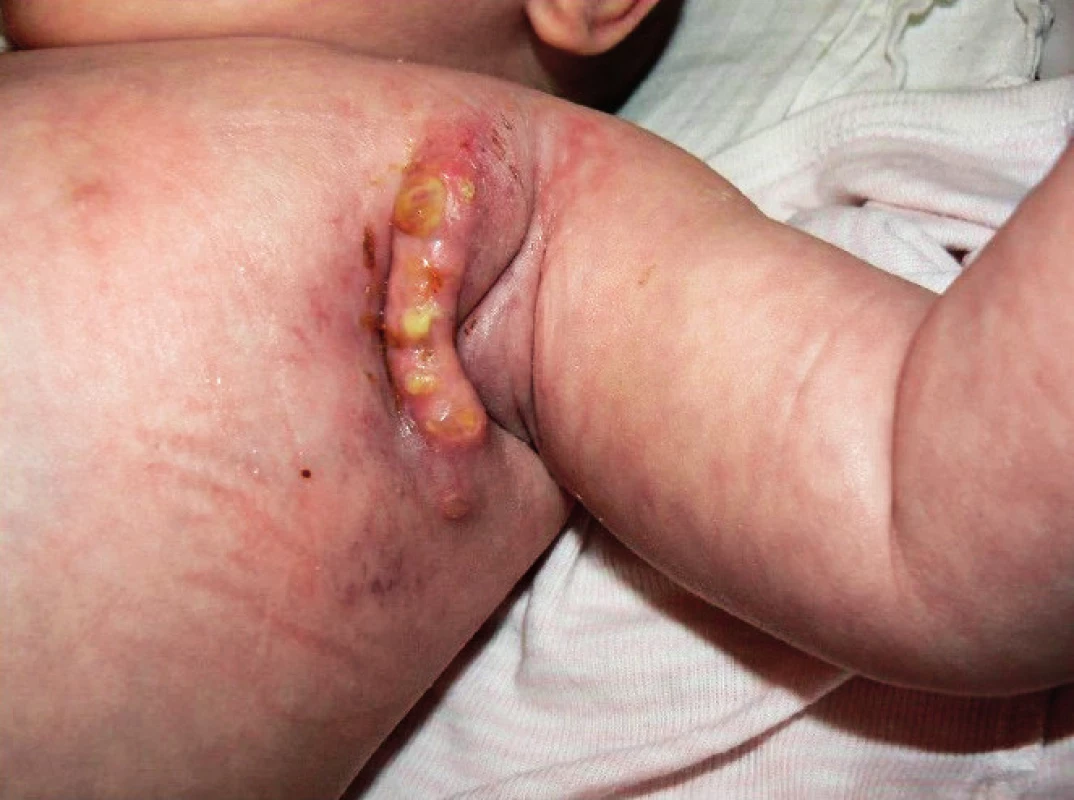 Komplikace hojení v axile 1 měsíc po exstirpaci uzliny.
Fig. 3. Post-operative complications in the wound, 1 month after the surgery.