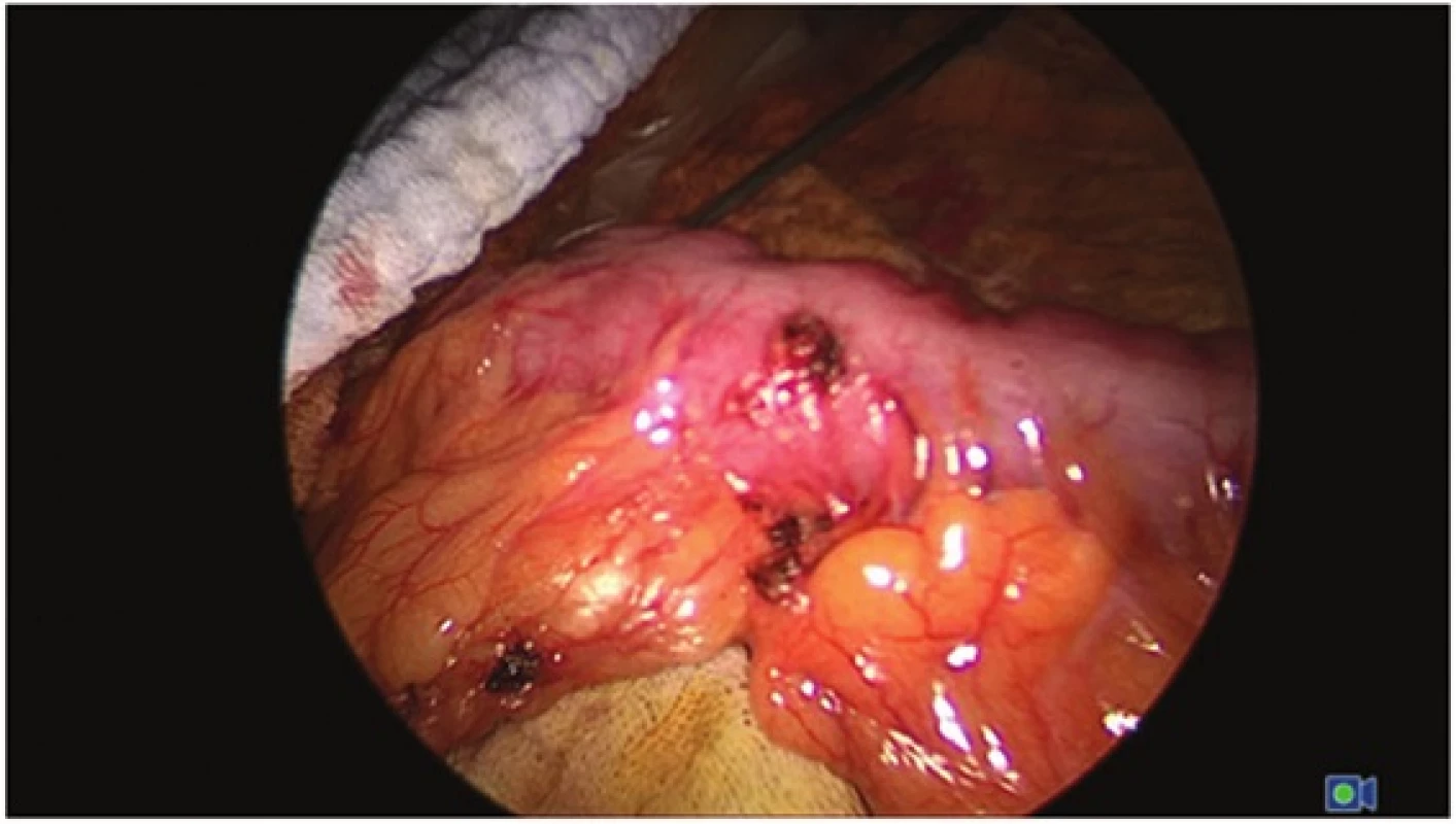 Střevní segment před aplikací ICG
Fig. 1: Bowel segment before ICG aplication