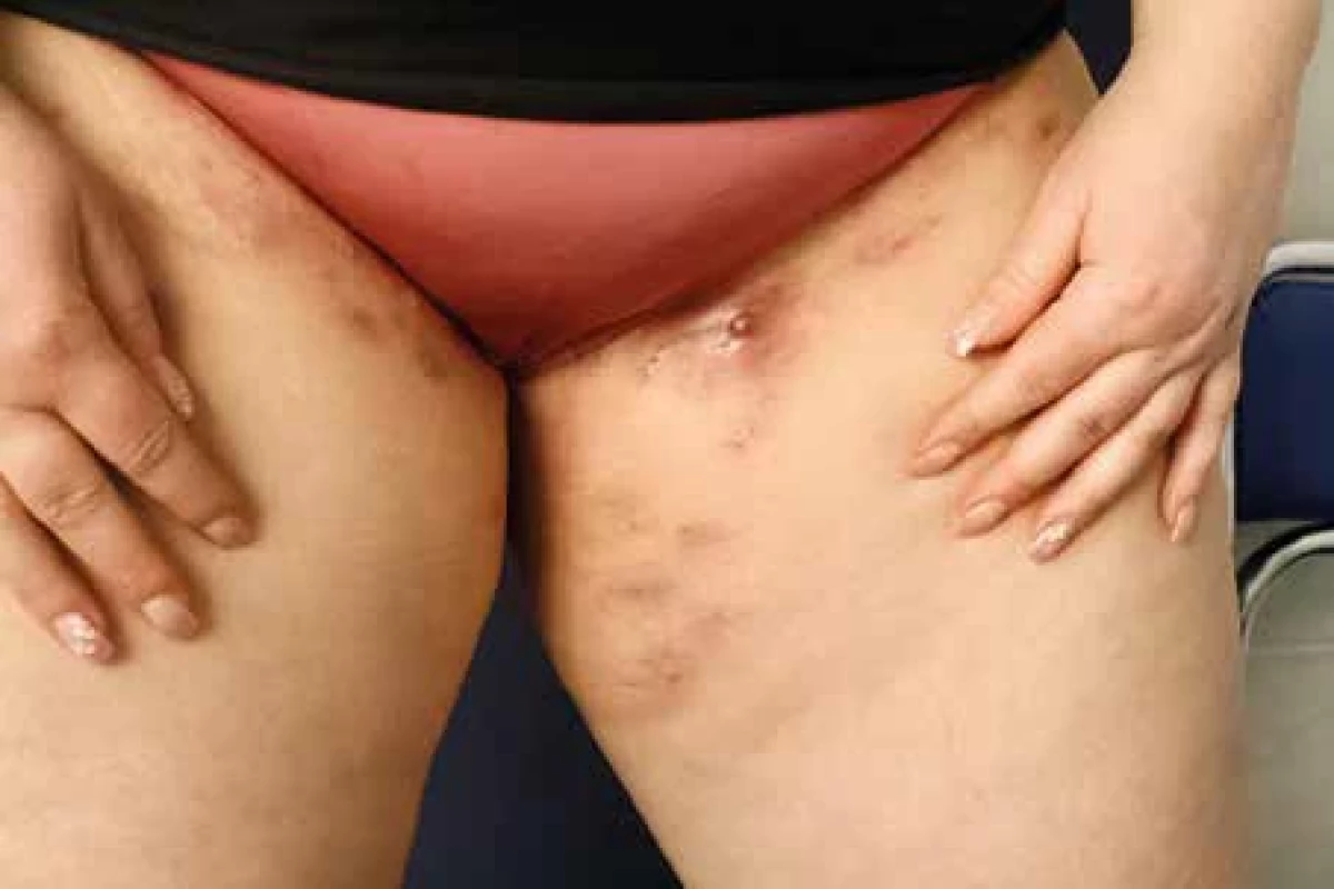 Hidradenitis suppurativa, stage I podle Hurleyho. [Foto: fotoarchiv Dermatovenerologické kliniky 2. LF UK, Fakultní nemocnice Bulovka]