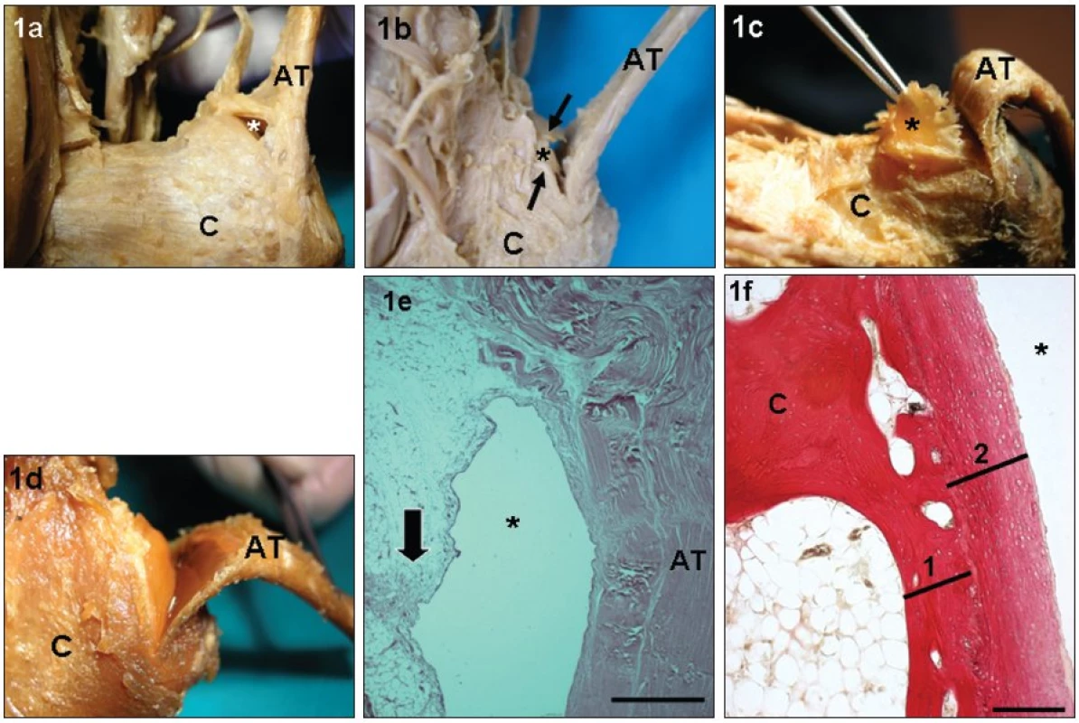 a. Pohled do dutiny retrokalkaneární burzy na anatomickém preparátu po otevření její laterální stěny
b. Pohled shora do dutiny RB po odklopení AT dorzálně. Jsou patrné volné okraje obou laloků synoviální řasy (šipky), volně vyčnívající do dutiny burzy
c. Úplná proximální everze celé synoviální řasy (*) z dutiny burzy
d. Pohled shora do dutiny burzy po úplném odstranění celého stropu. Přední plocha je AT je v rozsahu RB kryta synoviální membránou, a je proto zcela hladká ve srovnání s vazivem okolního peritenonia. Povrch tuber calcanei je v rozsahu RB krytý chrupavkou
e. Sagitální řez střední částí stropu retrokalkaneární burzy. Azan. Hematoxylin-eozin. Šipka – zadní plocha synoviální řasy těsně pod jejím přechodem na přední plochu Achillovy šlachy. Bar: 500 μm
f. Sagitální řez střední částí tuber calcanei hledící nazad do dutiny RB. Hematoxylin-eozin. 1 – povrchová vrstva kortikalis, 2 – chrupavčitý kryt kostního povrchu patní kosti. Bar: 100 μm
Fig. 1a. Lateral aspect into the cavity of the retrocalcaneal bursa (RB) after opening of its outer wall
b. Laterosuperior aspect into the cavity of the RB after maximal dorsal flexion of the Achilles tendon (AT). Free margins of both flaps of the synovial fold are apparent (arrows)
c. A complete elevation of the whole synovial fold (asterisk) from the cavity of the RB
d. Superior aspect into the cavity of the RB after total reflection of the bursa ceiling. The anterior surface of the AT is covered by the synovial membrane in the extent of the RB, and is therefore apparently very smooth – in comparison with the rough surrounding connective tissue of the peritenonium. The surface of the calcaneus (C) is covered with a layer of fibrous cartilage in the extent of the bursa
e. Sagittal histological section of the posterior part of the RB ceiling. Azan. Arrow designates the posterior surface of the fold just below its transition on the anterior surface of the AT. Bar: 500 μm
f. Sagittal section of the middle posterior surface of the calcaneal tuberosity. Hematoxylin-eosin. 1 – superficial cortical layer of bone, 2 – cartilagineous cover. Bar: 100 μm