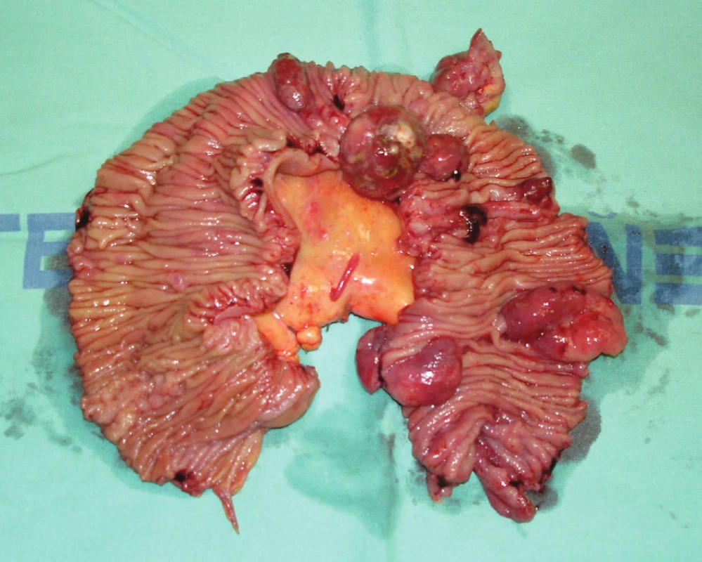 Resekát jejuna s infiltrací lymfomem
Fig. 8. Jejunal resecate with lymphoma infiltration