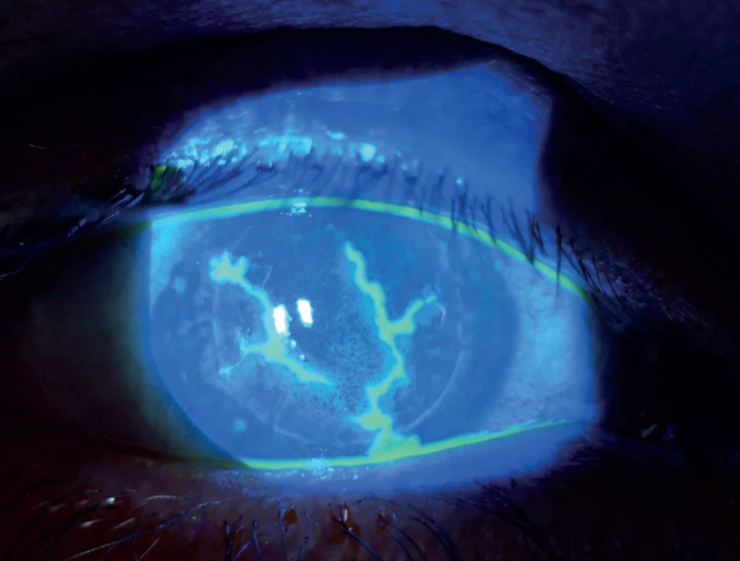 Dendritic keratitis of the graft in a patient after penetrating keratoplasty