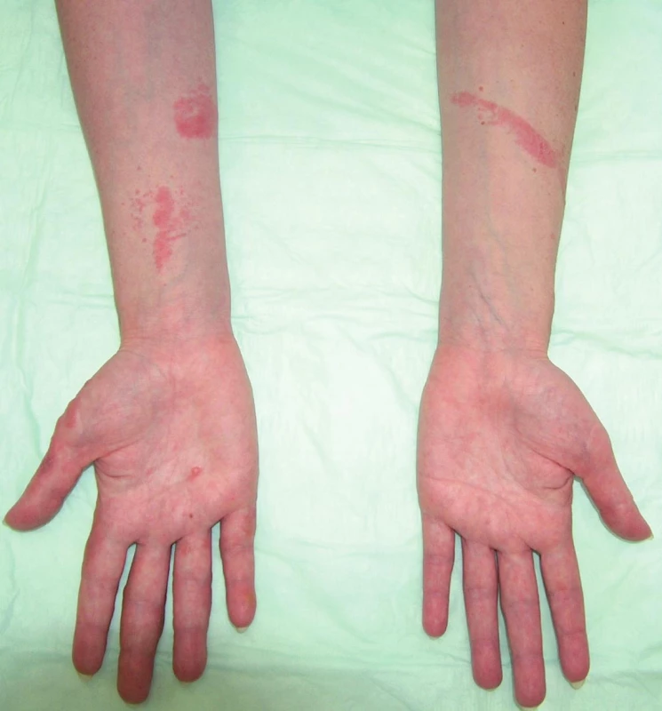 Fotoalergická kontaktní dermatitida (ketoprofen).