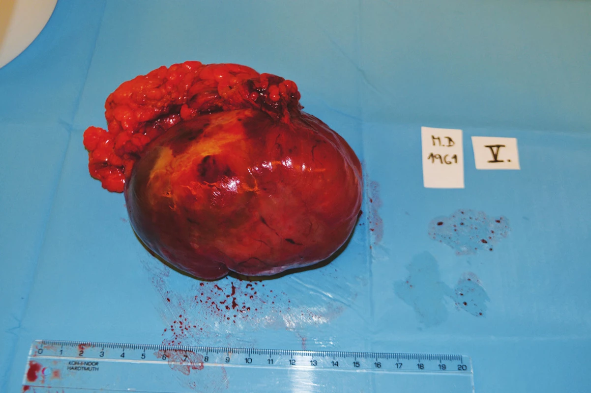 Infiltrát mezenteria po exstirpaci
Fig. 3: Mesenterial infiltrate after removal
