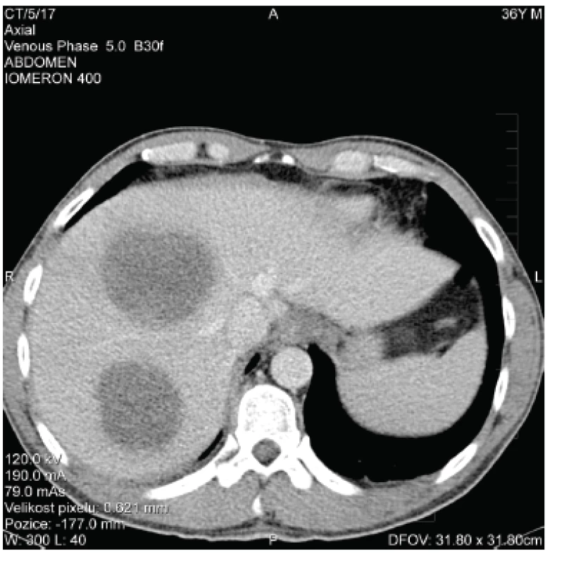 CT obraz jaterních abscesů – vstupní nález (zdroj: NRL pro diagnostiku střevních parazitóz, RNDr. Zuzana Hůzová)
Fig. 1. Baseline CT scan of liver abscesses (source: National Reference Laboratory for the Diagnosis of Intestinal Parasitoses, Zuzana Hůzová, MSc)