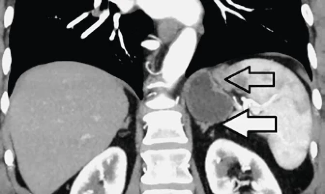 Divertikl fundu žaludku v těsném kontaktu se slezinou a nadledvinou (šipky) – frontální rovina. Stomach diverticulum in close contact with spleen and suprarenal gland (arrows) – frontal plane.