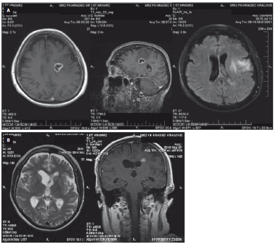 MRI scan of the brain of patient 1 on day 10 showing the brain abscess and ventriculitis with pathological content in the left lateral ventricle appearing as small abscesses (A) and day 62 showing a disappearance of the liquid in the site of the former abscess and signs of scarring in the surrounding tissue (B).
Obr. 1. MR vyšetření mozku pacientky číslo 1 ukazuje 6. den hospitalizace mozkový absces a ventrikulitis s patologickým obsahem v levé postranní komoře ve formě malých abscesů (A) a 62. den vymizení tekutiny v místě původního abscesu se známkami jizvení v okolní tkáni (B).