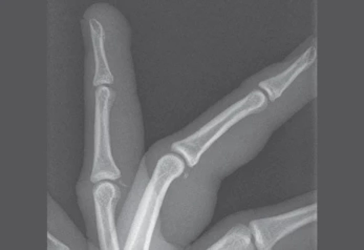 Instable proximal interphalangeal joint volar plate injury with a large displaced fragment for operative treatment.