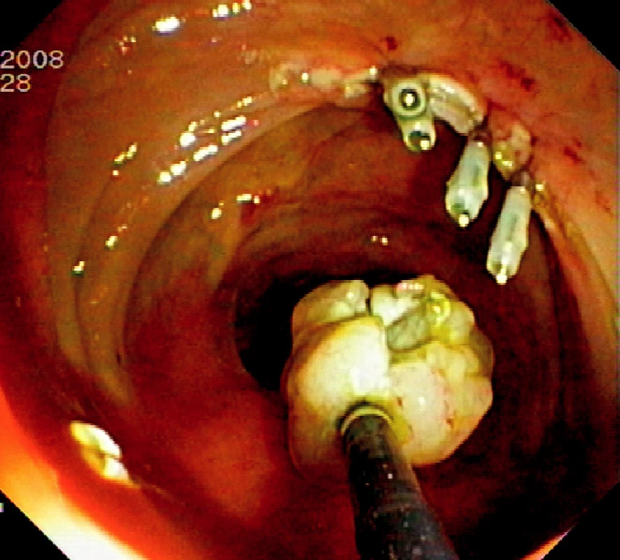 Ošetření spodiny 4 endoklipy a vybavení resekátu tripodem
Pic. 4. The resection base closed by four endoclips and recovery of the specimen using tripod catheter