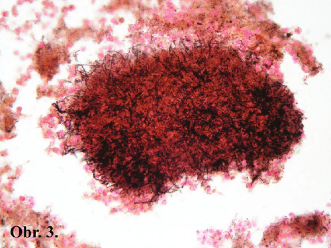 Kolónie vláknitých mikroorganizmov znázornených striebrením podľa Grocotta. Grocott, 400x
Fig. 3: Colony of filamentous microorganisms, Grocott’s silver stain, 400x