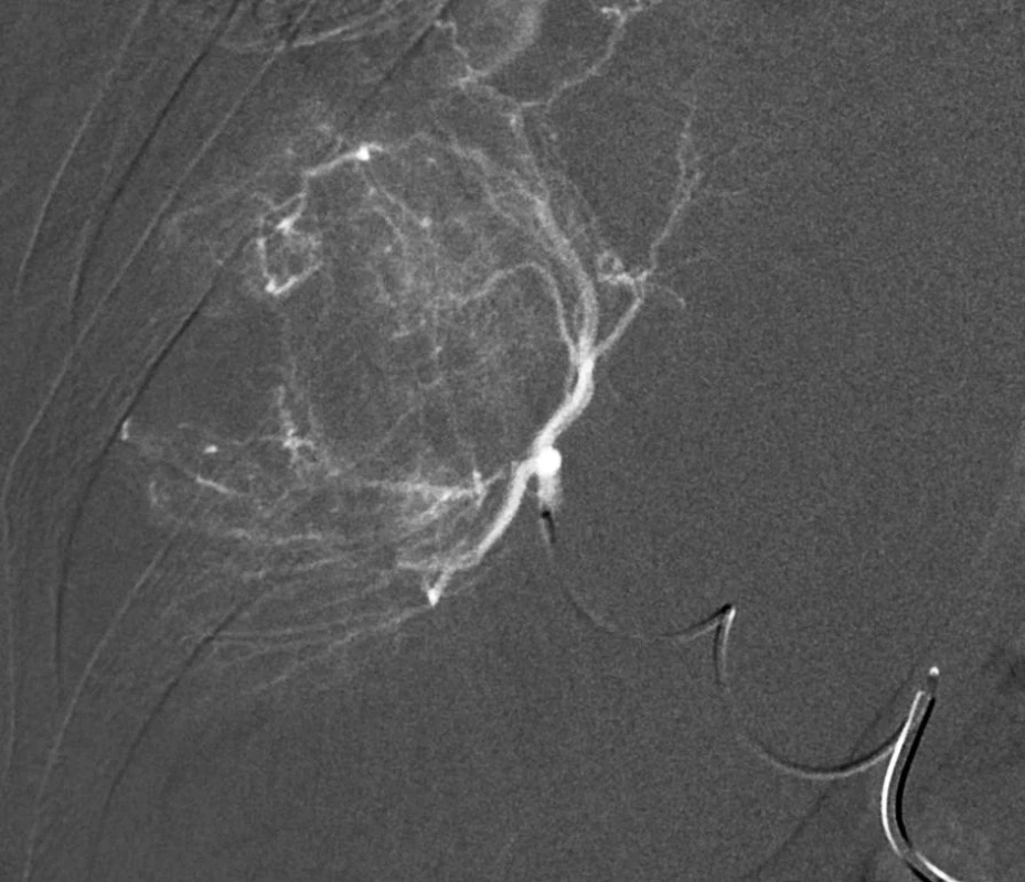 Superselektivní nástřik nutritivní tepénky mikrokatétrem před chemoembolizací – digitální subtrakční angiografie.
Fig. 2: Super-selective angiography of the nodule-nutritive branch by means of a microcatheter before chemoembolization.