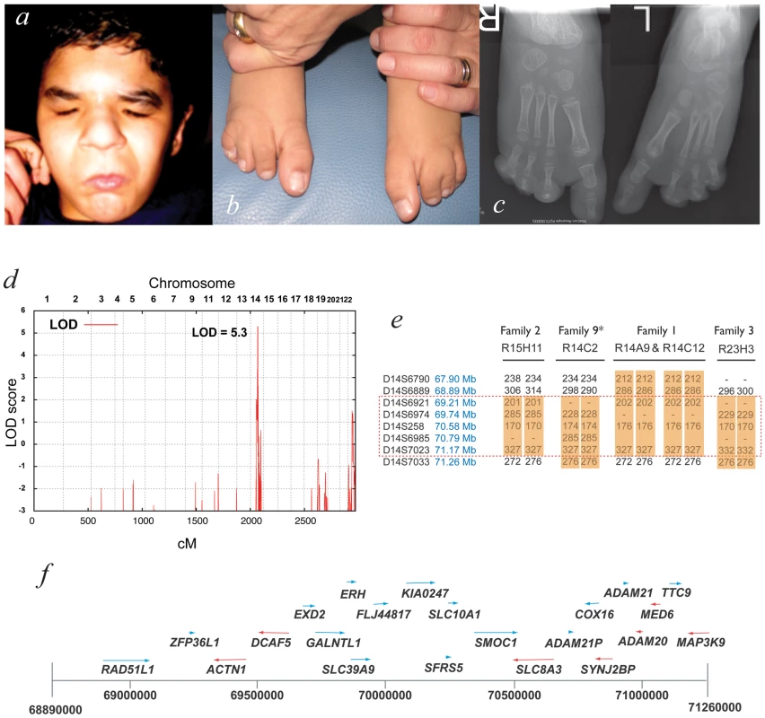 Mapping ophthalmo-acromelic syndrome.