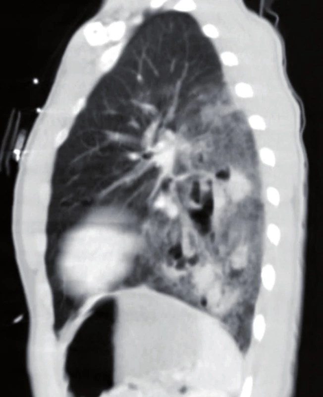 Sagital CT