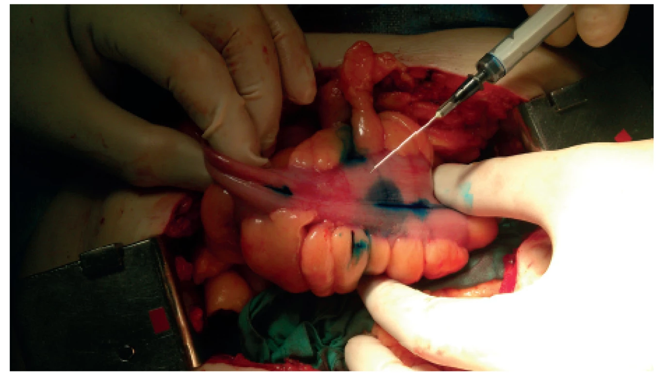Nástřik tumoru peritumorálně subserózně do čtyř kvadrantů
Fig. 1: Patentblue dye injection peritumorously subserosally