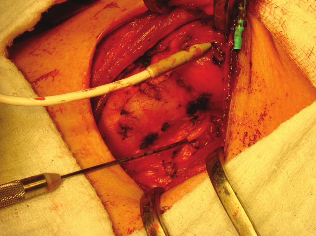 Neuromonitoring n. rekurens
Fig. 1: Neuromonitoring of the recurrent nerve