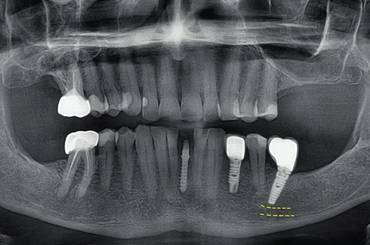 Meziální sklon apexu dovolí zavedení delšího implantátu