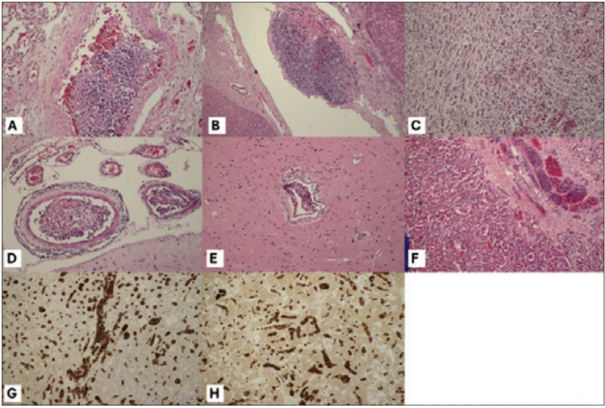 Histologické a imunohistologické nálezy. Obrázky A–F ukazují řezy barvené hematoxylin-eosinem, obrázek G zobrazuje řez barvený protilátkami proti CD20 a obrázek H zobrazuje řez barvený protilátkami proti CD79a. (A) Nádorové buňky v plicní cévě; (B) v jaterní cévě; (C) nadledvina, nádorové buňky v sinusoidech, útlak buněk nadledviny; (D) céva v meningách s nádorovými buňkami; (E) cerebrální céva s nádorovými buňkami; (F–H) hypofýza Fig. 2. Histological and immunohistochemical fi ndings. Figures A–F show sections stained with hematoxylin and eosin; Figure G shows a section stained with antibodies against CD20; and Figure H shows a section stained with antibodies against CD79a. (A) Tumor cells in a pulmonary vessel; (B) in a hepatic vessel; (C) adrenal gland, tumor cells in the sinusoids, compression of adrenal cells; (D) a vessel in the meninges with tumor cells; (E) cerebral vessel with tumor cells; (F–H) pituitary gland