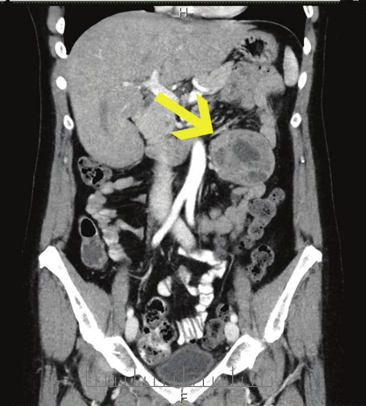 CT s tumorem v levém mezogastriu, koronární řez
Fig. 1: CT scan with tumour in the left mesogastrium, coronary section