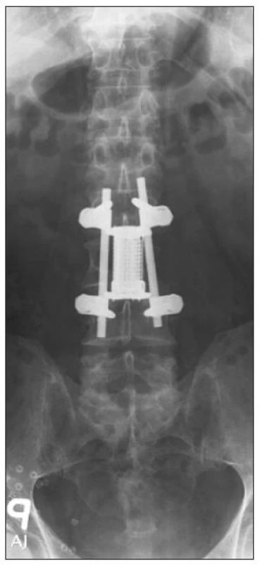 Skiagram lumbosakrální páteře, předozadní. Pooperační stav po kombinované stabilizaci obratle L3.
Fig. 5. Plain x-ray, lumbosacral spine, A-P view. Postoperative examination following combined L3 stabilization