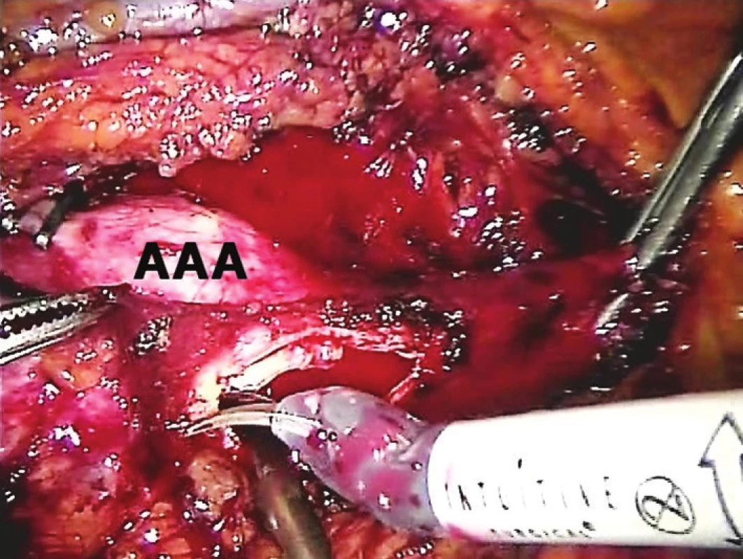 Otevírání vaku AAA
Fig. 4: Aneurysmal sac opening
