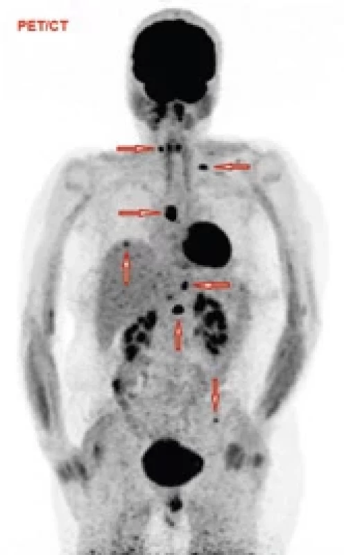 PET/CT, nález květen 2022. Šipky ukazují na mnohočetné metastázy sterna, C a Th páteře, žebra, pánve a jater.