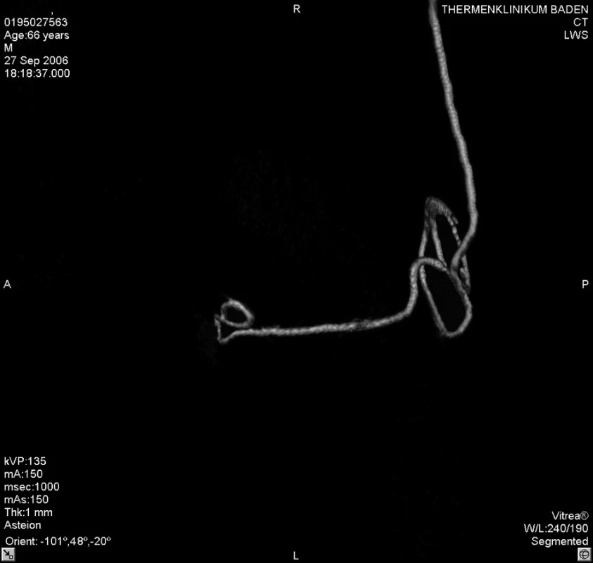 3D zobrazení tvaru epidurálního katétru po počítačovém odstranění struktur bederní páteře