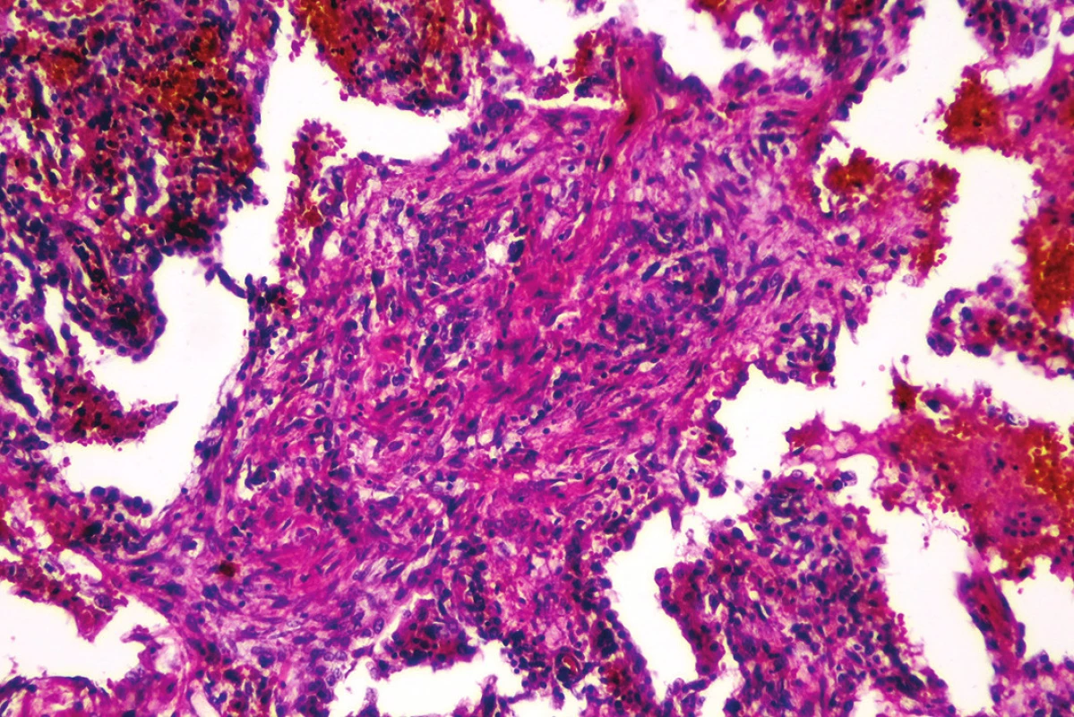 Rozšírenie alveolárnych sept podmienené fibrózou s lymfoplazmocytárnou infiltráciou (hematoxylín-eozín, zväčšenie 100x).