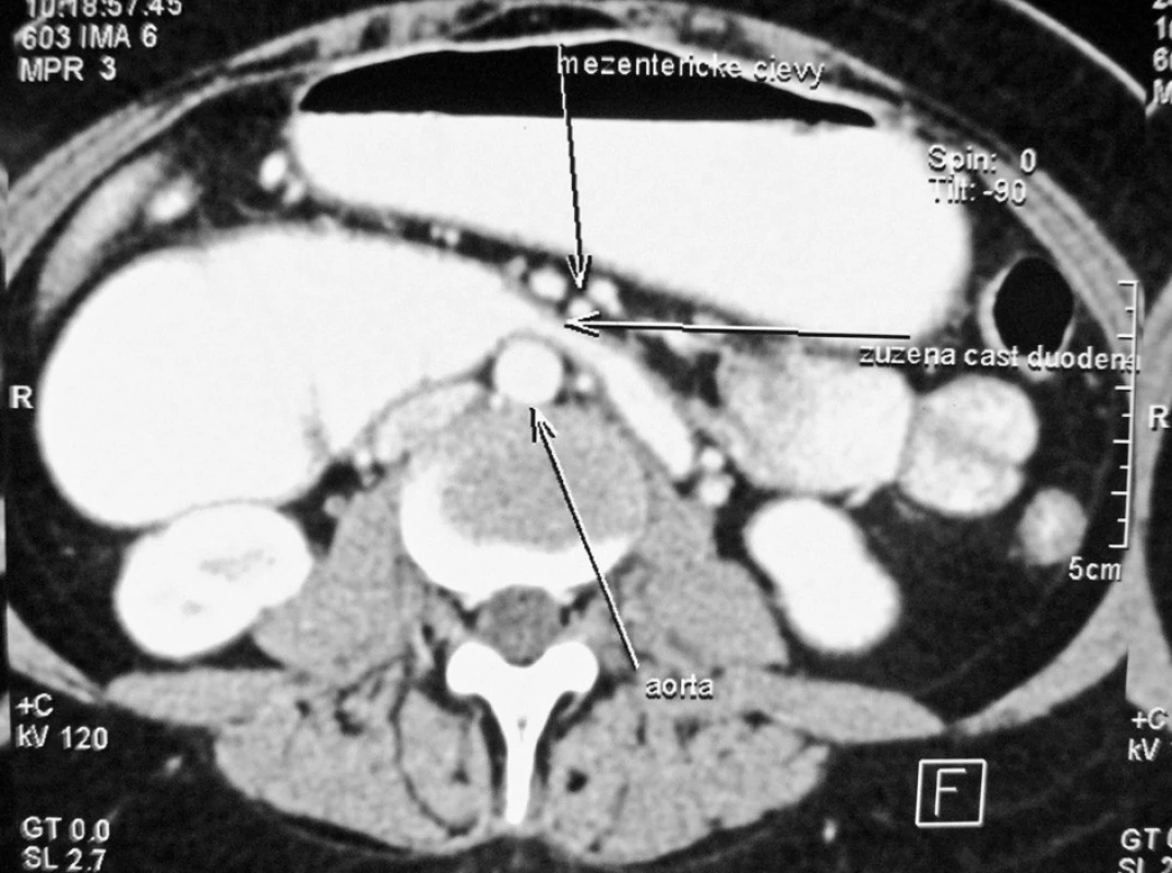 CT scan v axialnej rovine. Zobrazuje kompresiu     duodéna medzi AA a AMS
Fig. 3. CT scan, axial plane. Compression of the duodenum between the AA and SMA (AMS) is apparent