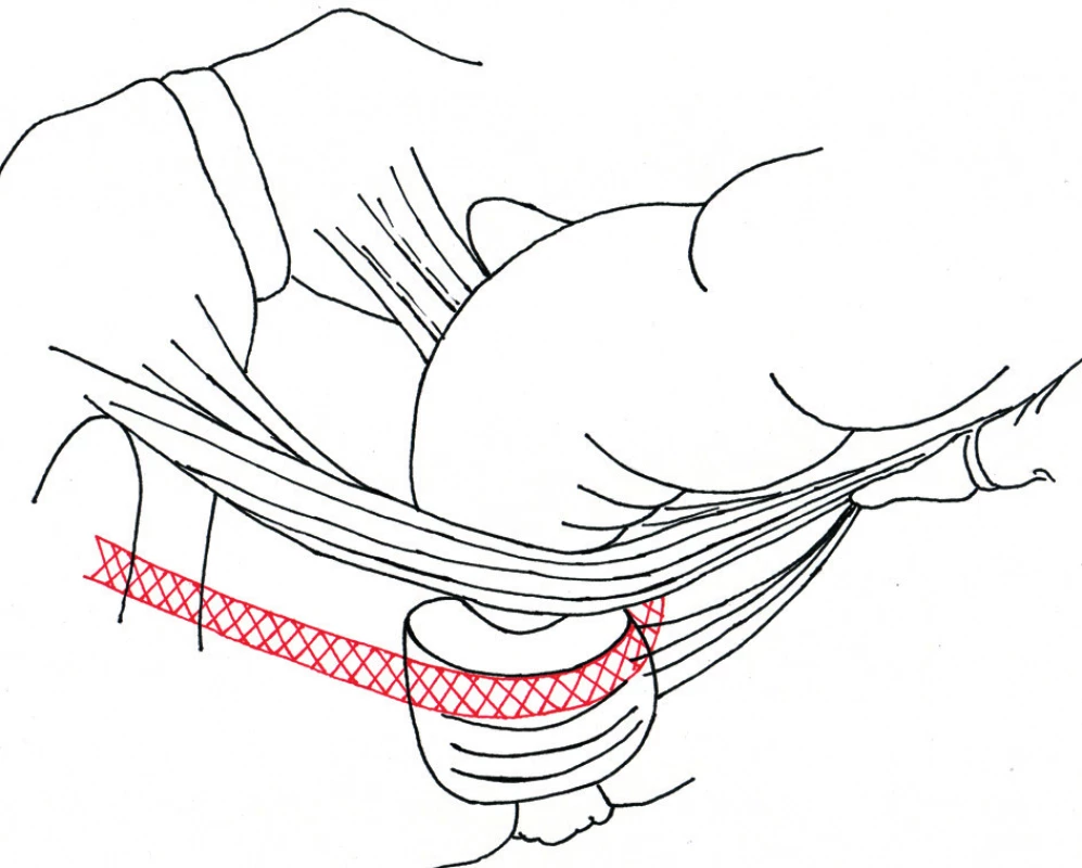 Schéma umístění pásky – bočný pohled
Fig 2: Outline of position of a anal sling – lateral view