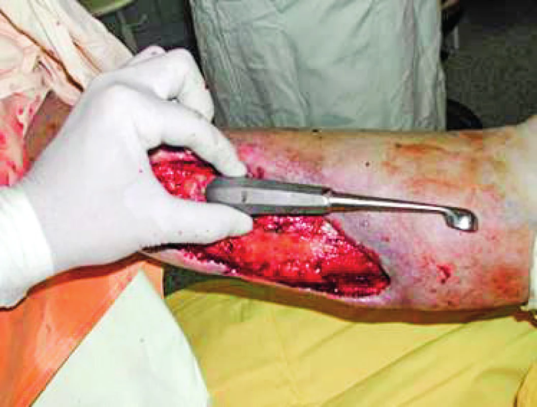 Same patient after surgical debridement of the wound. Note the deep undermining of the wound
