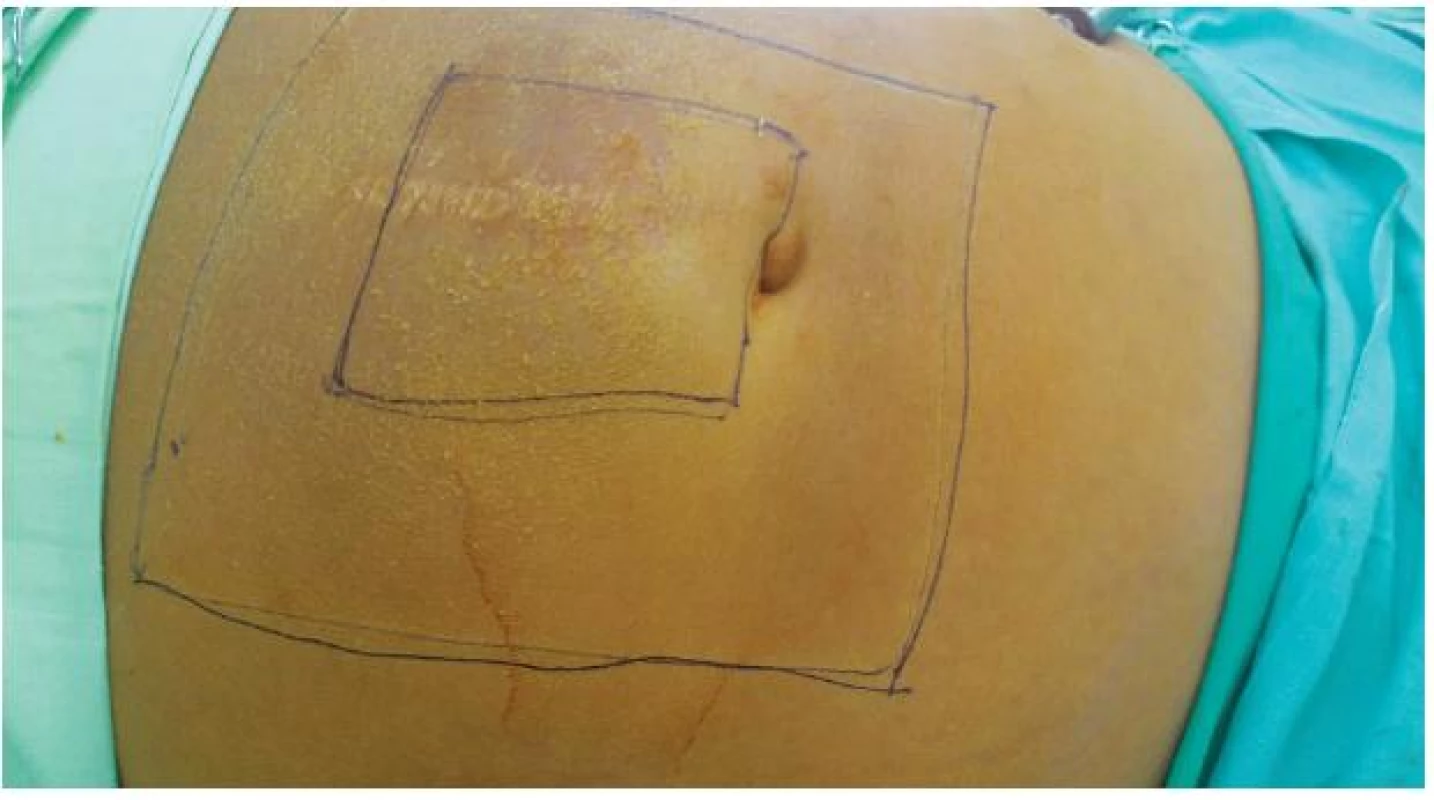 Označená hranica bránky hernie a plánovaná veľkosť sieťky
Fig. 1: Size of hernial defect and used mesh marked on the abdominal wall