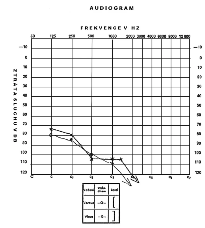 Audiogram 3. pacienta ve věku 3 let s nálezem velmi těžké ztráty sluchu