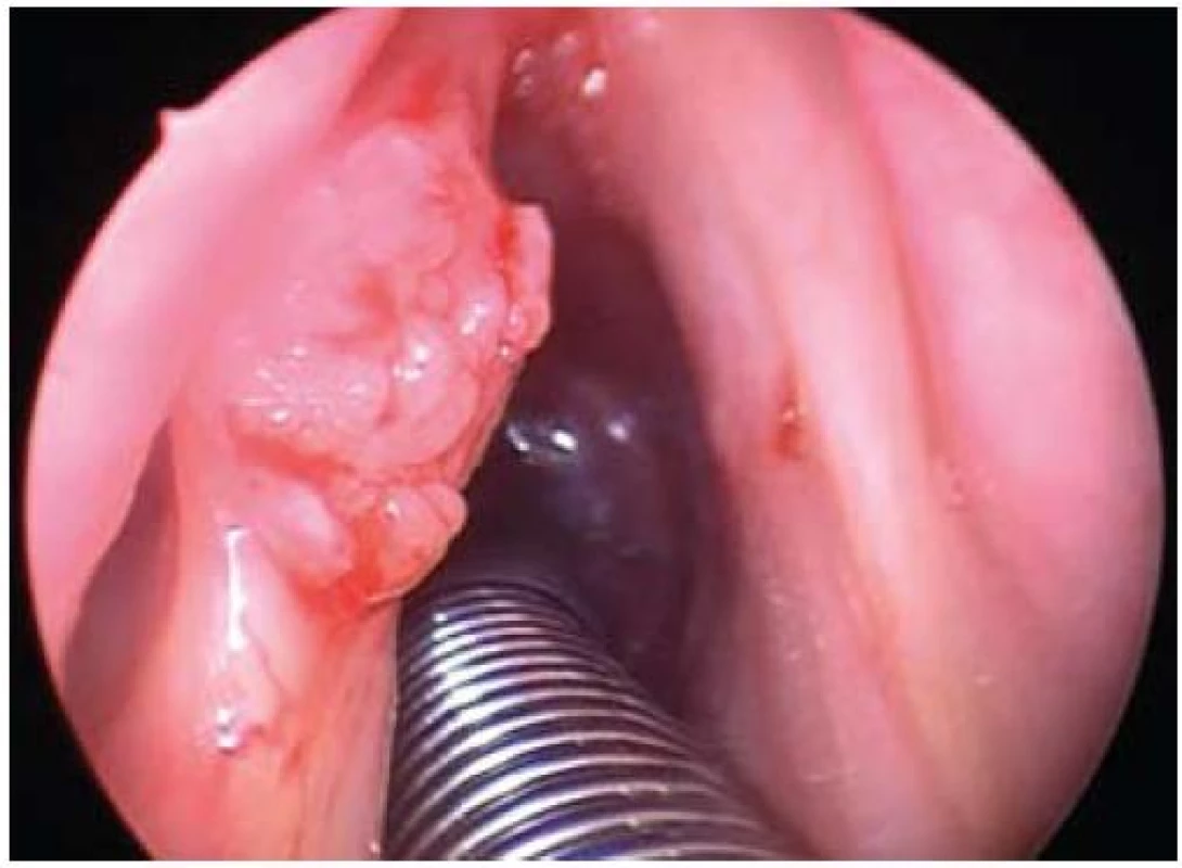 Karcinom levé hlasivky stadia T1.
Fig. 2. T1 carcinoma of the left vocal cord.
