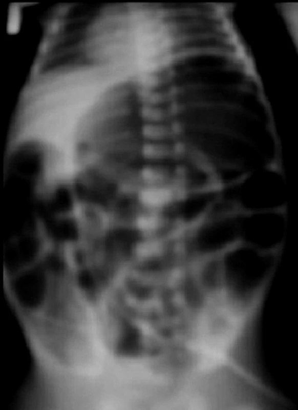 Abnominálna distenzia gastrointestinálneho traktu u trojdňového novorodenca.
Fig. 1. Abdominal distension of gastrointestinal tract in the three days old newborn.