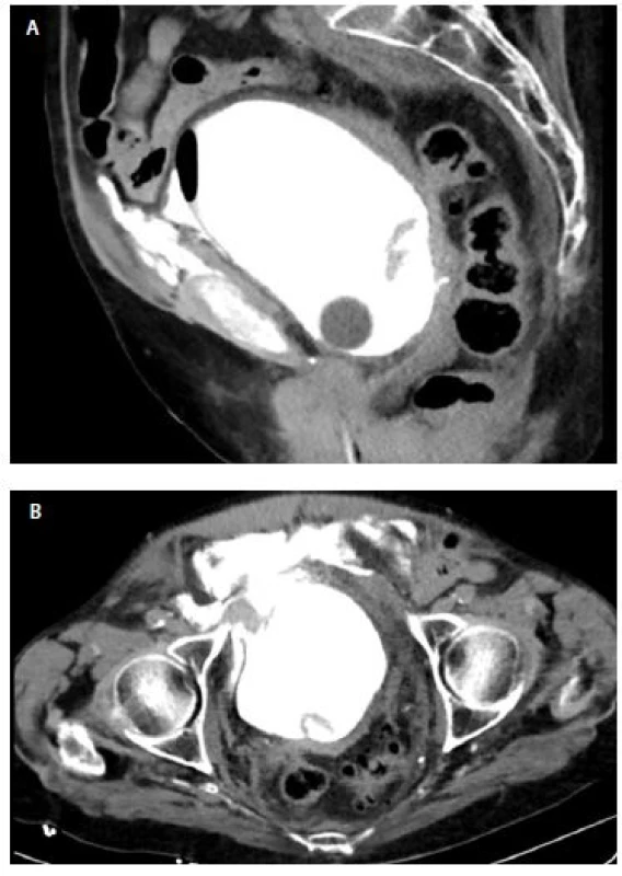 A, B CT cystografie
s velkou náplní, sagitální řez
(3A) a axiální (3B) je patrný extraperitoneální
únik kontrastní
látky<br>
Fig. 3. A, B CT cystography
on further filling of the bladder,
sagittal (3A) and axial (3B)
view extraperitoneal leakage
of contrast is demonstrated