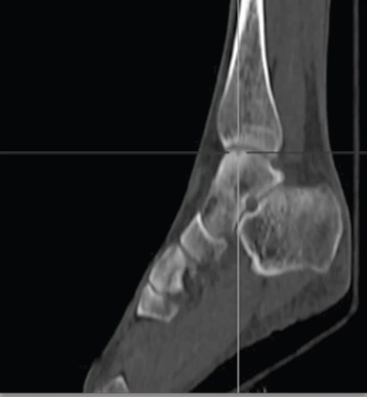 LDCT pravého talu v sagitálním řezu – osteochondrální defekt v kloubní ploše kladky pravého talu.